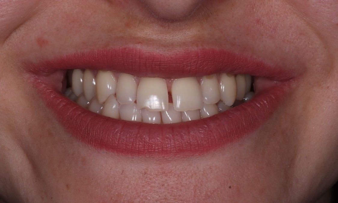 До/Після Вініри