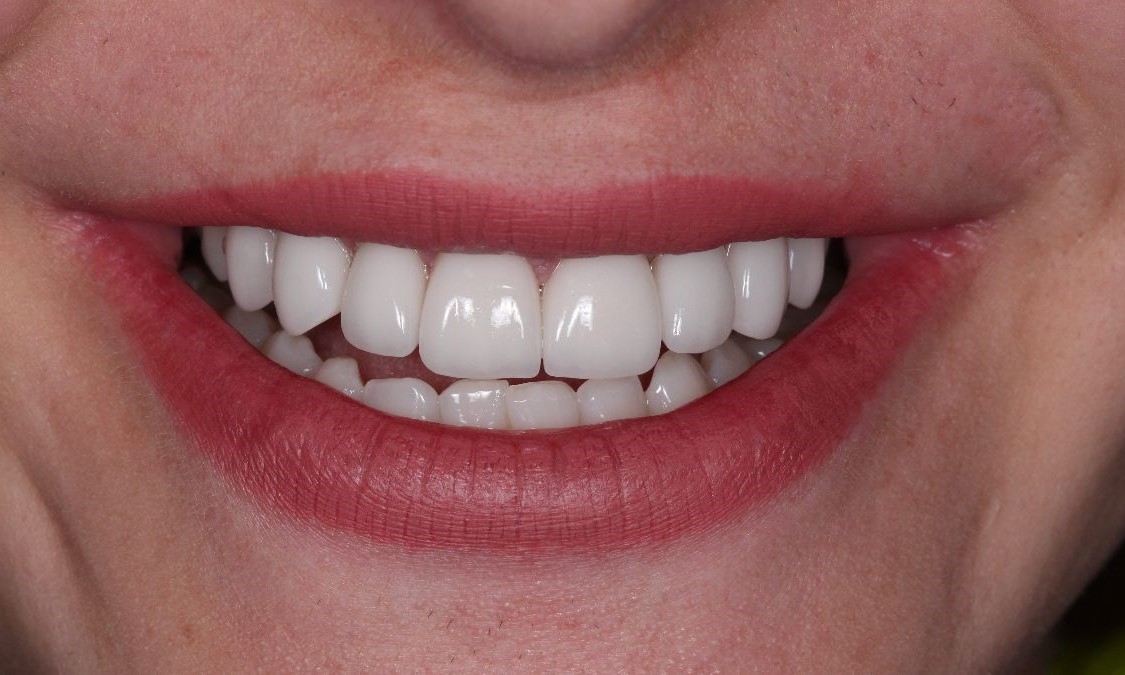 До/Після Вініри