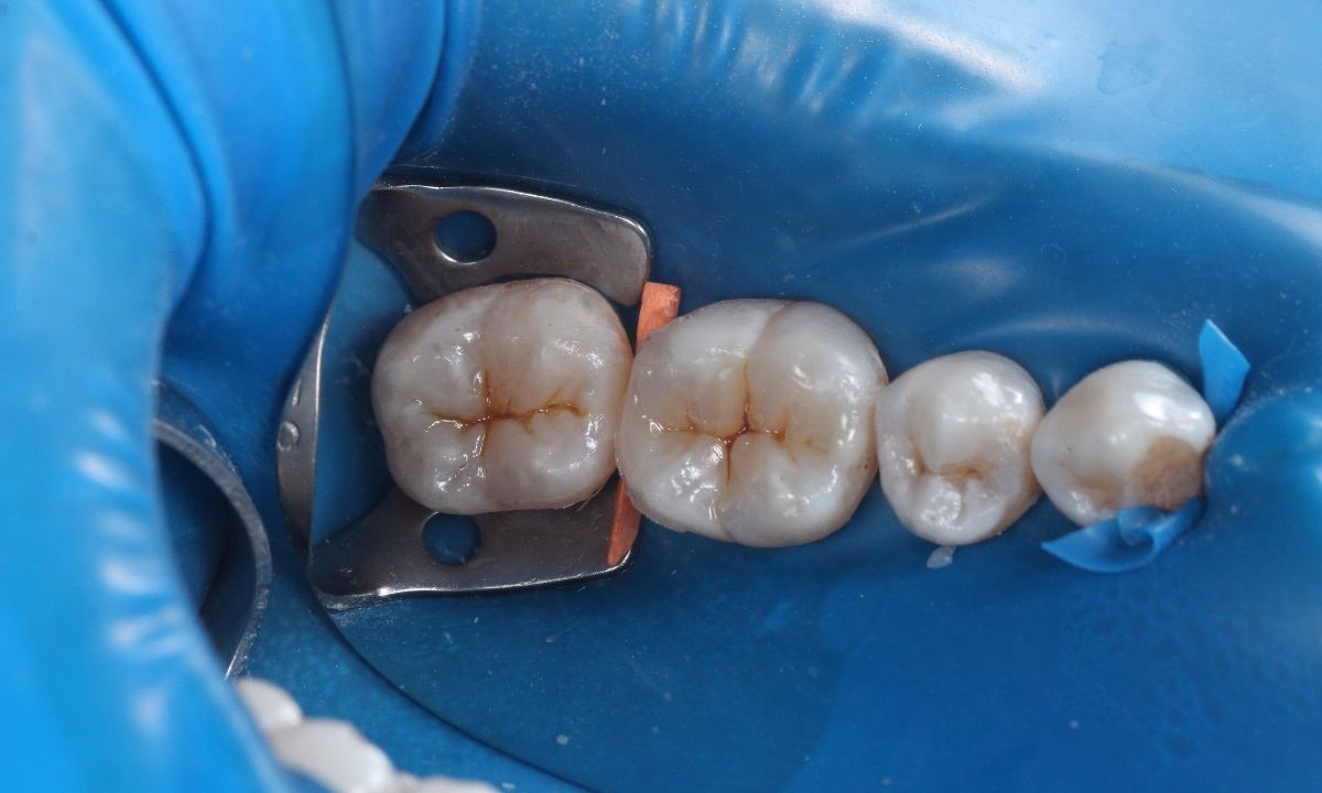 Після (Терапія)