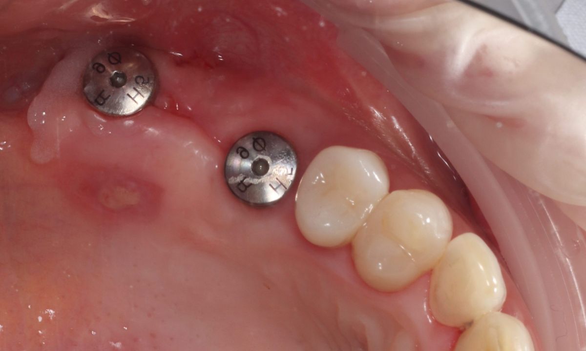 До (Імплантація)