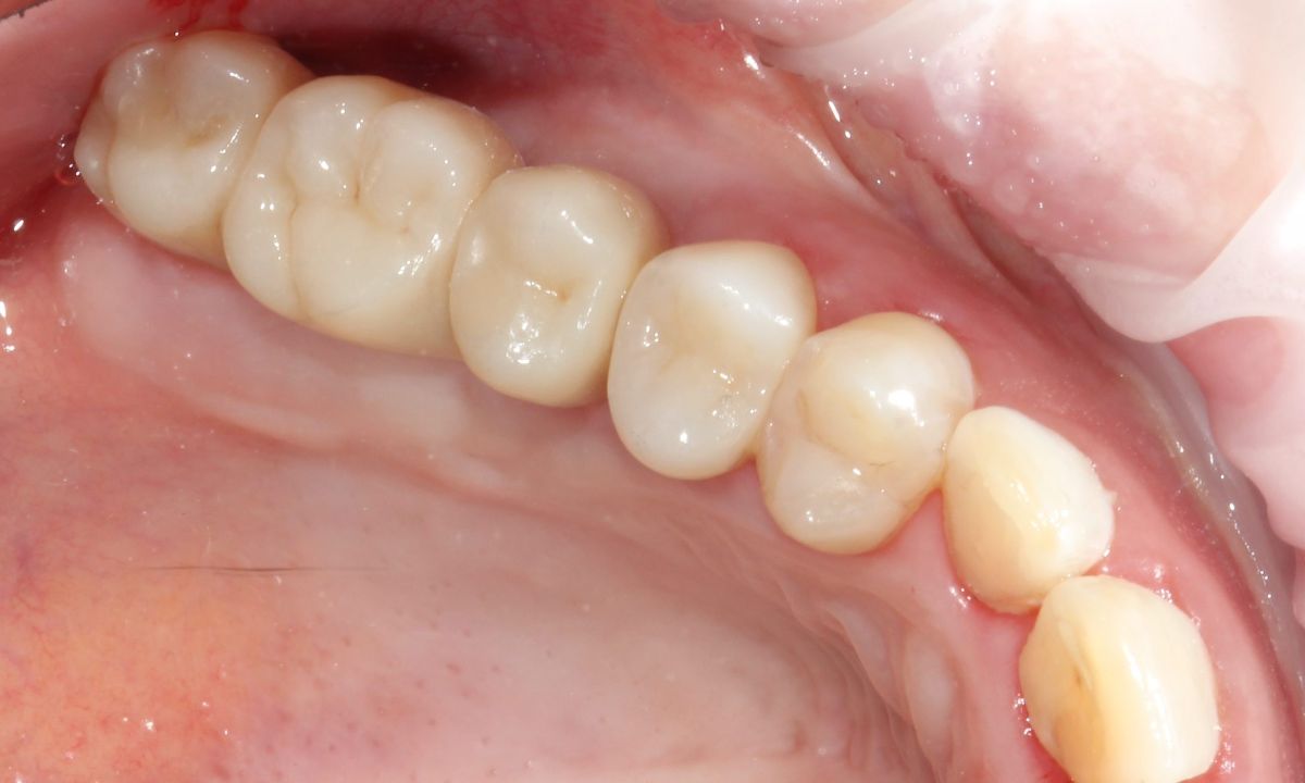 Після (Імплантація)