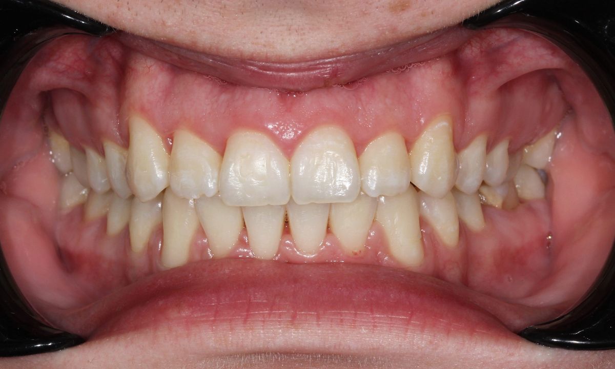 Після (Ортодонтія)