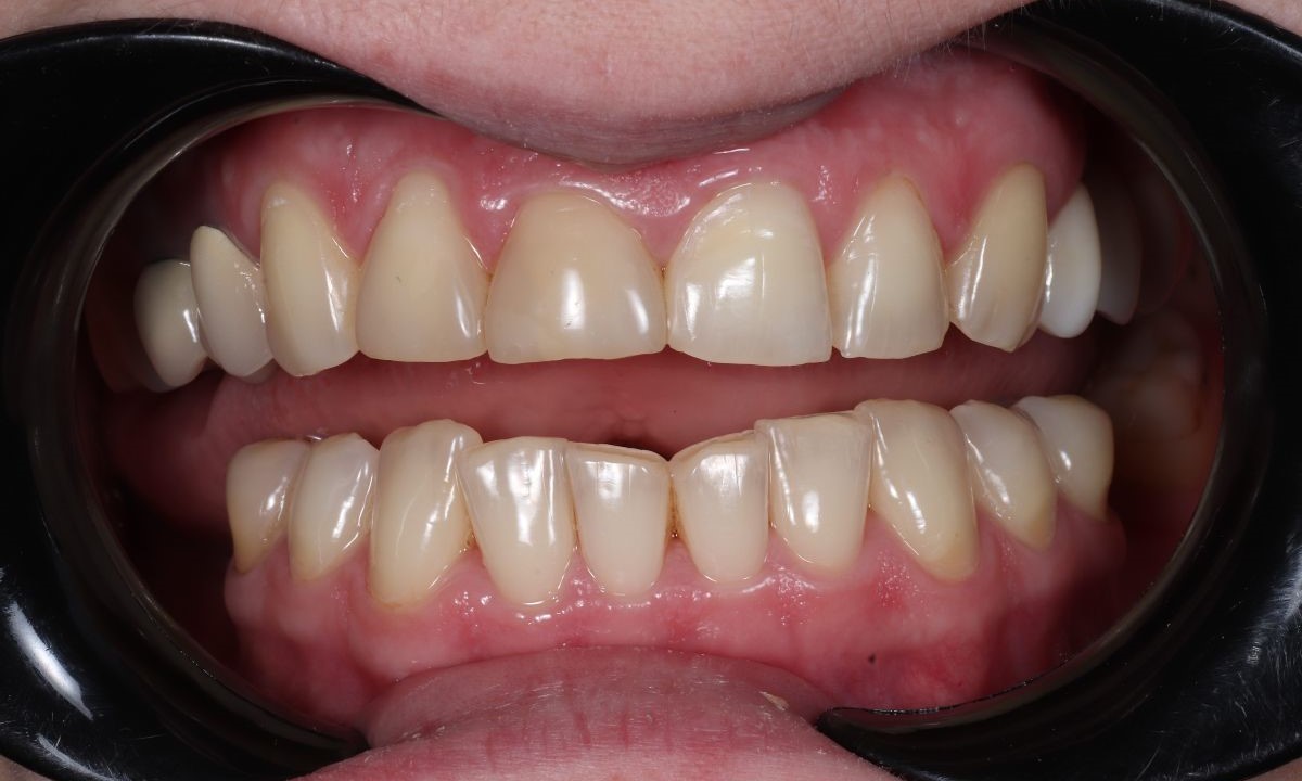 До (Відбілювання зубів)