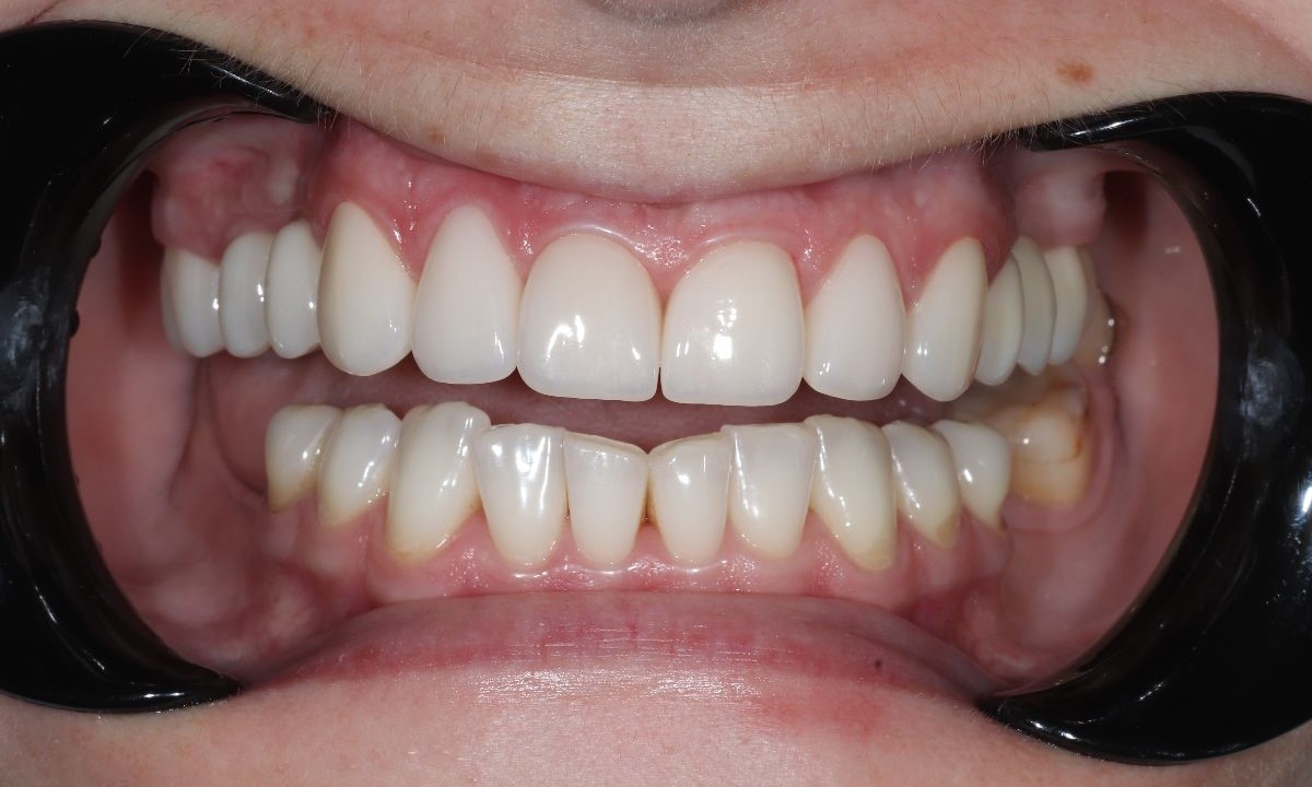 Після (Відбілювання зубів)