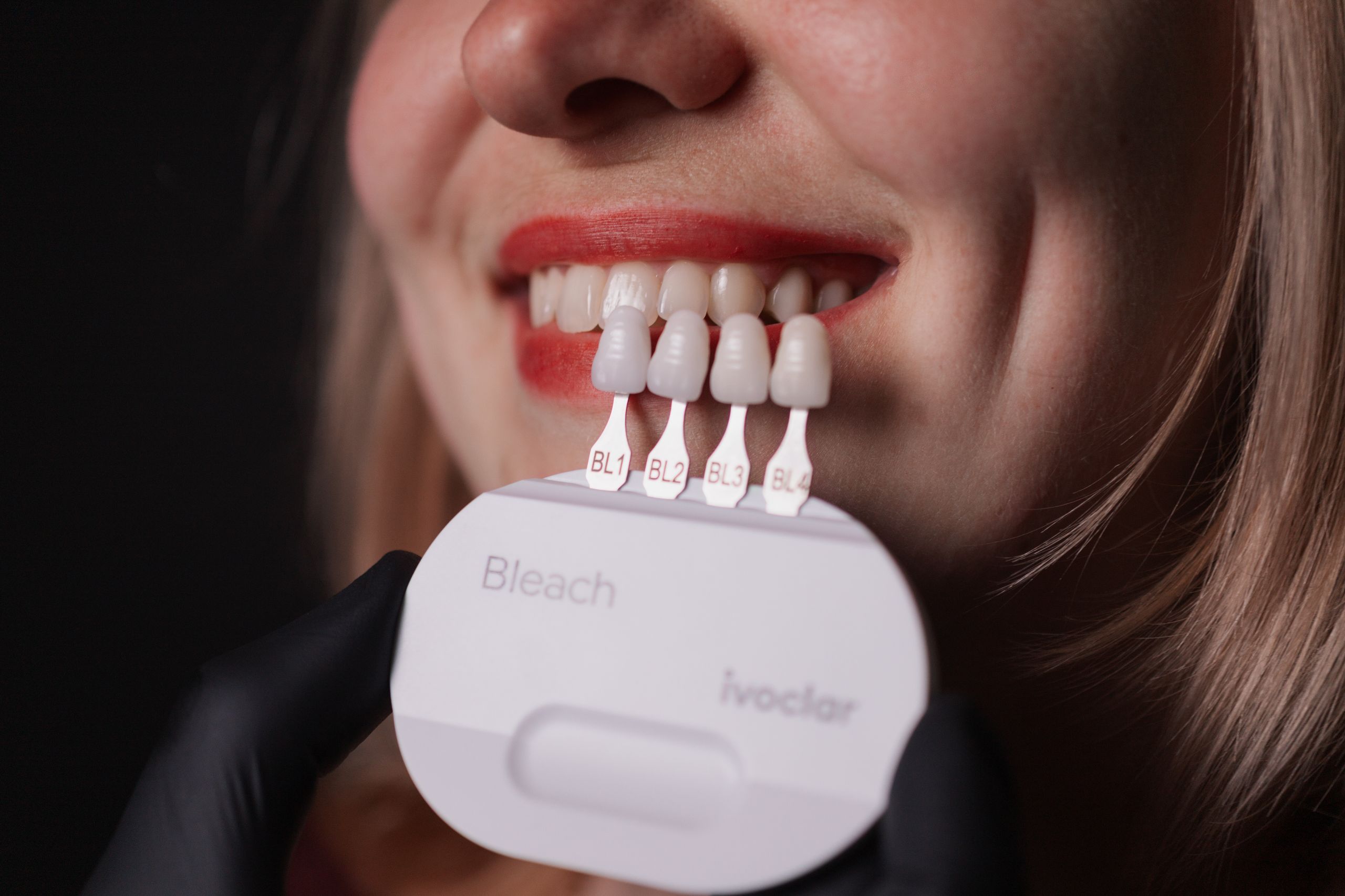 Вініри GeneralDental